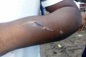 A mark of horse bit on the arm of a student in Phulia. NfN Picture