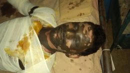 Blast victim Goutam Das at Saktinagar district hospital in Krishnanagar