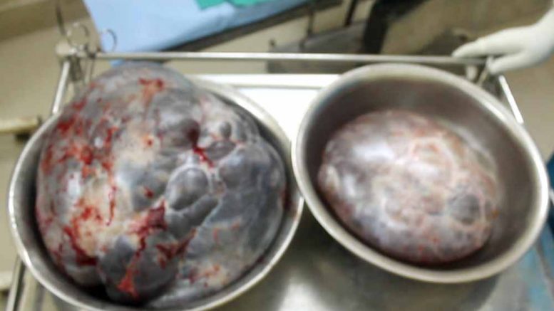 Tumors removed from Arati Adhikary's ovary at Kalyani JNM Hospital